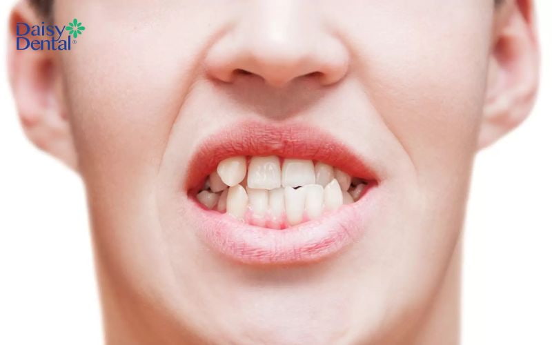 Răng lệch gây mất thẩm mỹ và ảnh hưởng đến chức năng ăn nhai