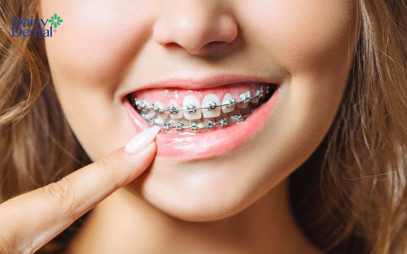 Niềng răng giúp khắc phục tình trạng răng lệch nhân trung hiệu quả