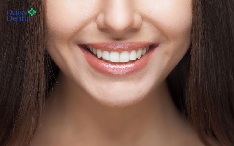 Bọc răng sứ giúp khắc phục tình trạng răng lệch nhân trung nhanh chóng