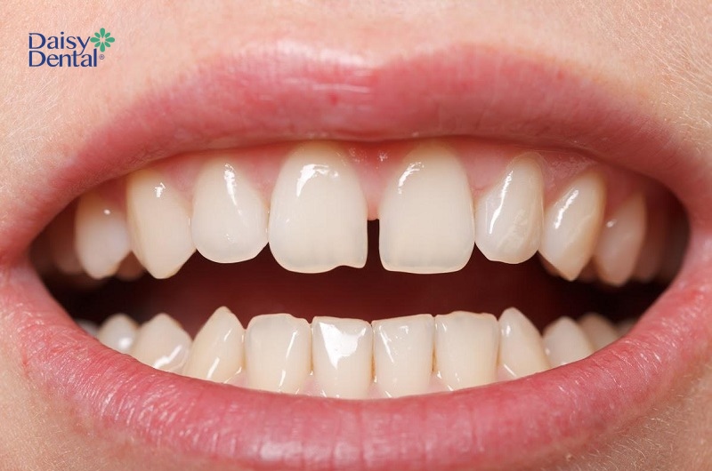 Răng thưa hở kẽ tạo nên khoảng trống giữa các răng gây mất thẩm mỹ và ảnh hưởng đến khả năng ăn nhai