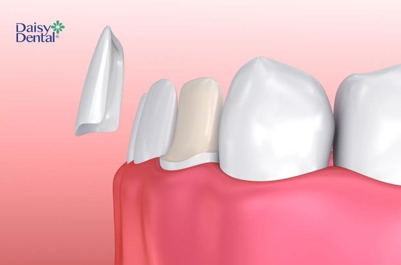 Dán sứ Veneer là phương pháp được nhiều khách hàng lựa chọn để cải thiện răng thưa.