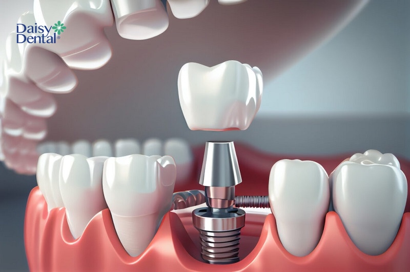Trụ Implant được làm từ Titanium nên an toàn và lành tính cho người sử dụng