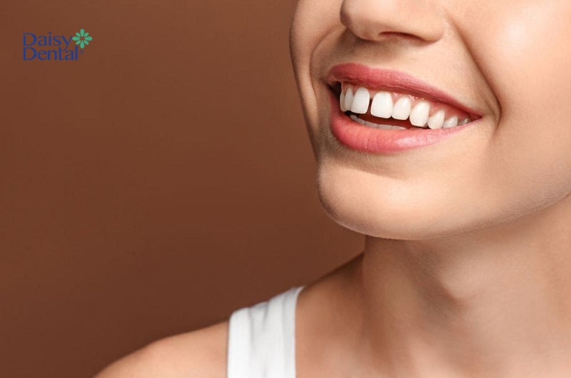 Răng thưa gây mất tính thẩm mỹ nụ cười khiến người bệnh tự ti trong giao tiếp.