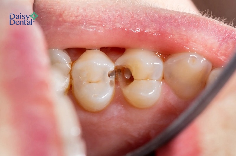 Răng bị thưa có thể dẫn đến các bệnh lý răng miệng như sâu răng.
