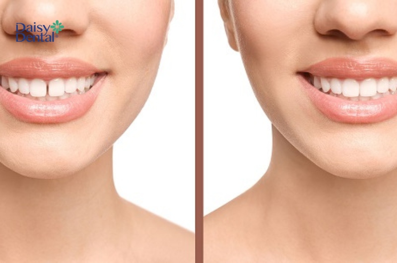 Trám răng là một trong những phương pháp giúp khắc phục tình trạng răng bị thưa hiệu quả cao.