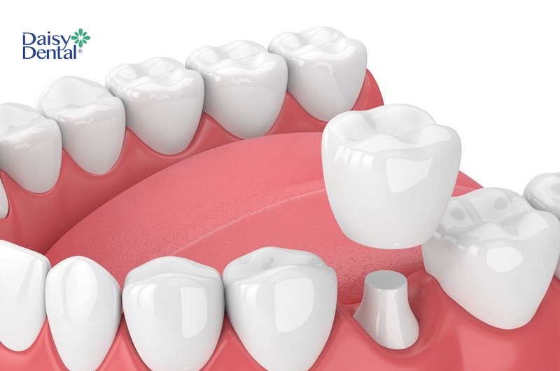 Bọc răng sứ được áp dụng trong trường hợp răng thưa hở kẽ lớn, giúp khôi phục dáng răng hoàn hảo, đảm bảo chức năng ăn nhai và tính thẩm mỹ.