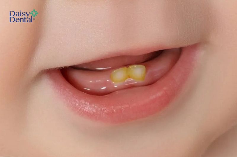 Răng trẻ bị ố màu do di truyền từ bố mẹ