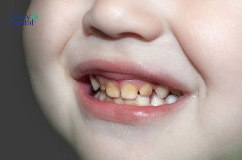 Hỗ trợ bé dưới 1 tuổi vệ sinh răng miệng bằng rơ lưỡi