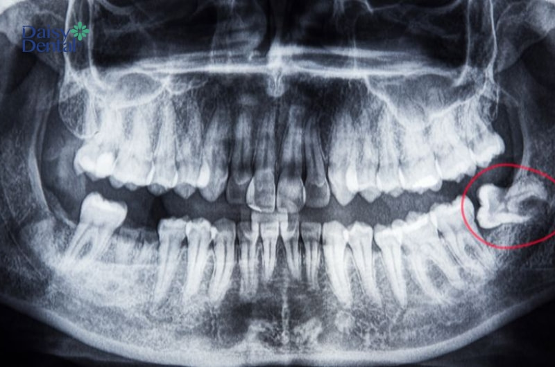 Vị trí mọc răng khôn