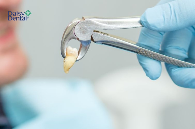 Răng khôn rất dễ bị sâu nên cần phải nhổ bỏ