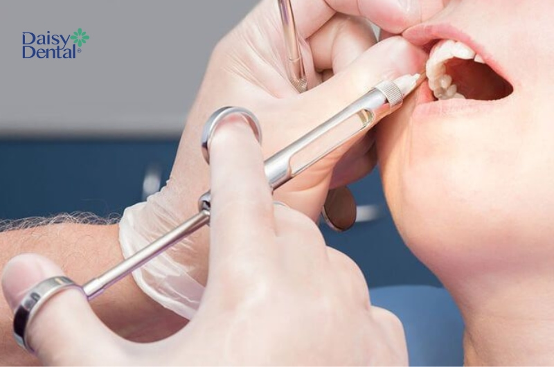 Khi nhổ răng, tiểu phẫu, bác sĩ thường tiêm thuốc tê để giảm đau nhức cho khách hàng.