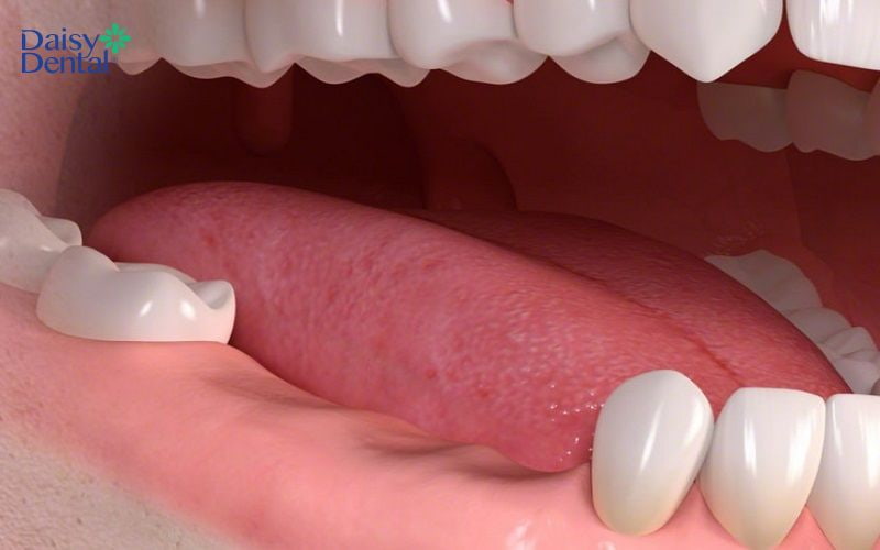 Mất răng nếu không được điều trị dẫn đến tình trạng biến chứng tiêu xương hàm