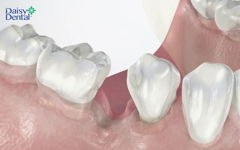 Tiêu xương hàm theo chiều dọc