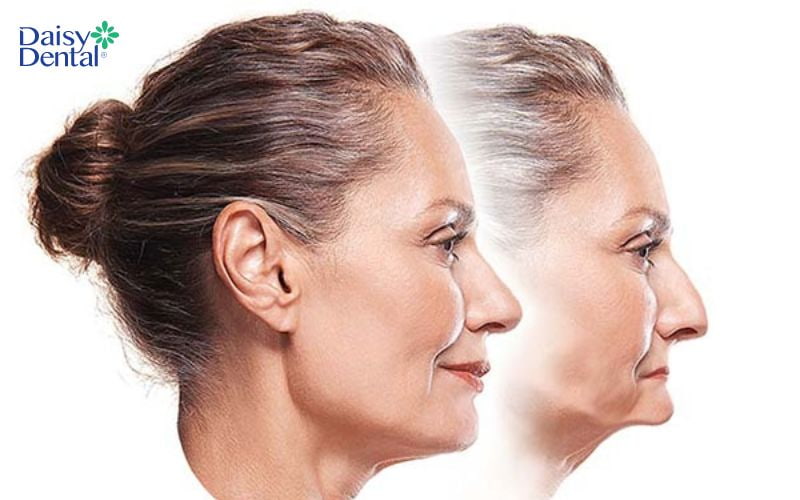Tiêu xương hàm gây ảnh hưởng đến tính thẩm mỹ khuôn mặt