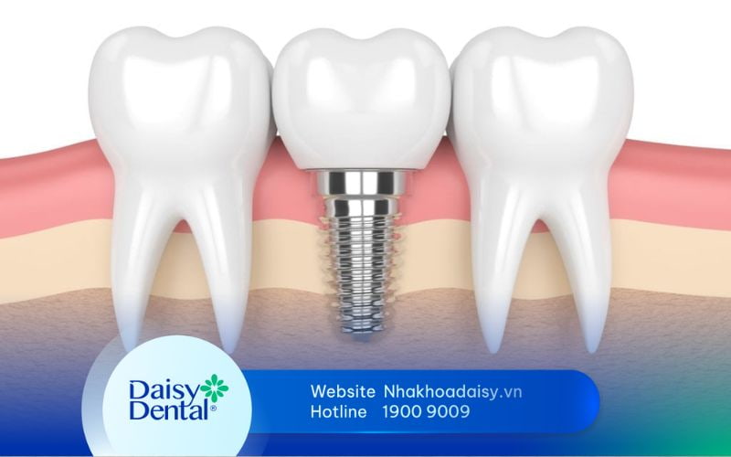 cấu tạo răng Implant