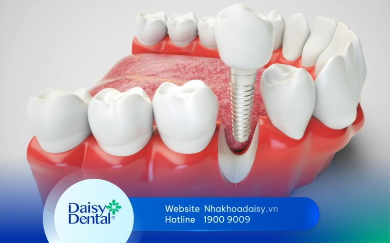 Kinh nghiệm trồng răng Implant
