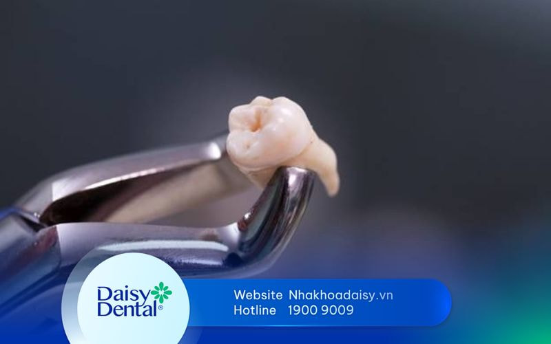 nhổ răng đã lấy tủy có đau không