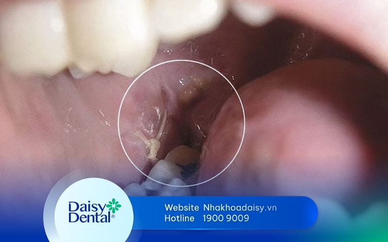 nhổ răng khôn bị nhiễm trùng