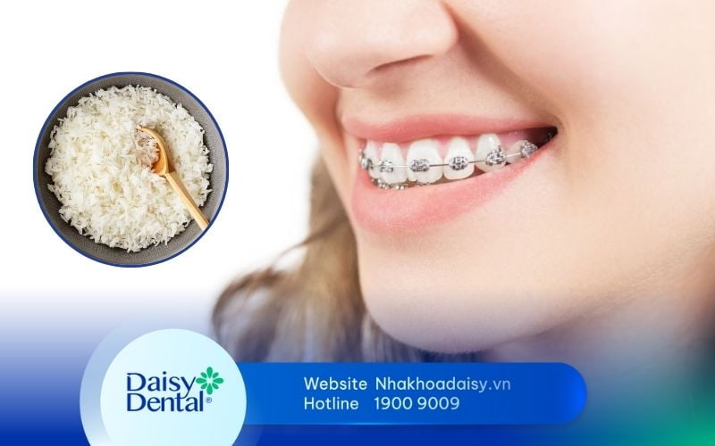 niềng răng bao lâu thì ăn được cơm