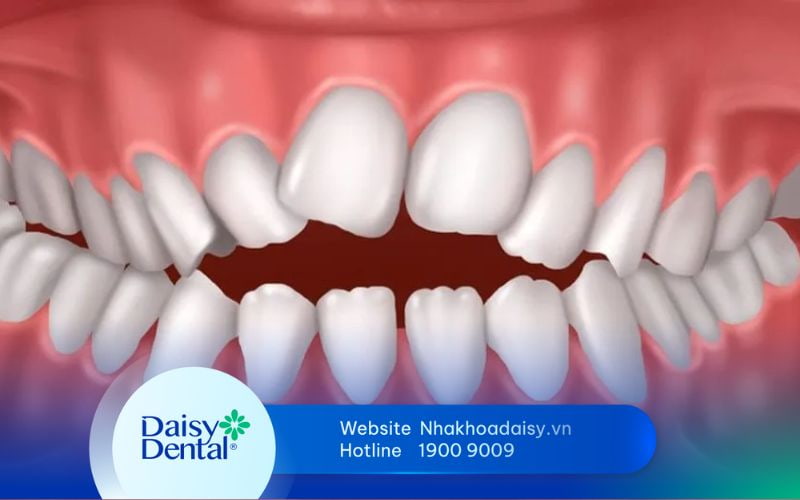 niềng răng khớp cắn hở mất bao lâu