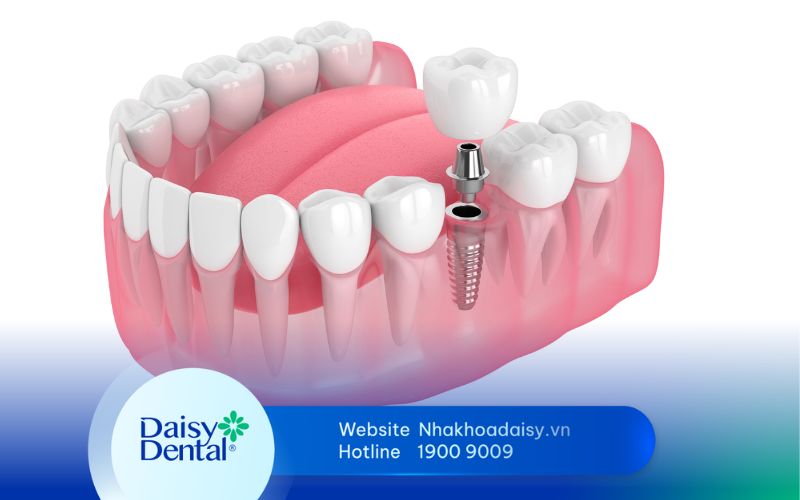 phục hình răng sứ trên Implant