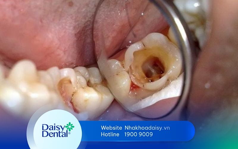 trị sâu răng vĩnh viễn tại nhà