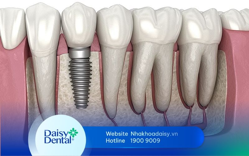 tuổi thọ răng Implant