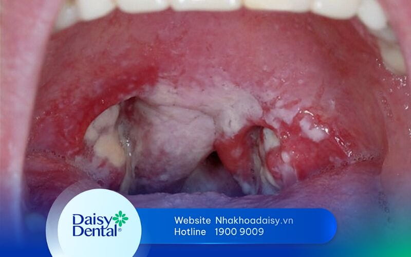Viêm họng do liên cầu khuẩn