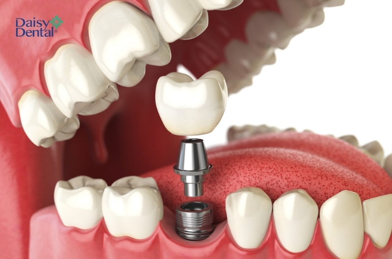 Cấy ghép Implant là kỹ thuật phục hình răng tiên tiến nhất hiện nay