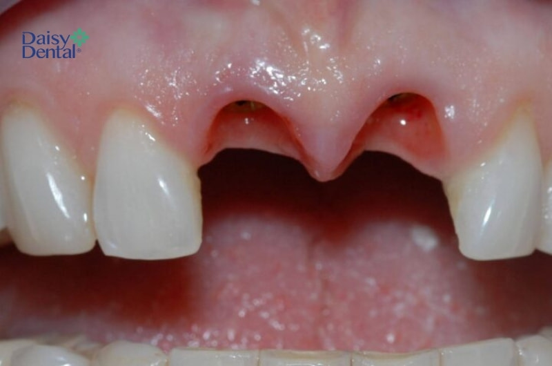 Mọi người thắc mắc: “Trẻ em trồng răng Implant có được không?”