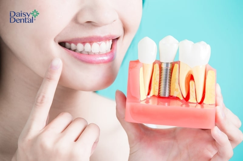 Trẻ đủ tuổi trưởng thành thì sẽ được tiến hành trồng răng Implant