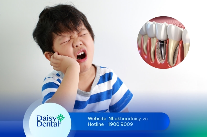 Trẻ em trồng răng Implant