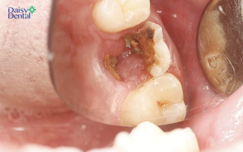 Sâu răng vĩnh viễn nếu không được điều trị kịp thời có thể gây mất răng