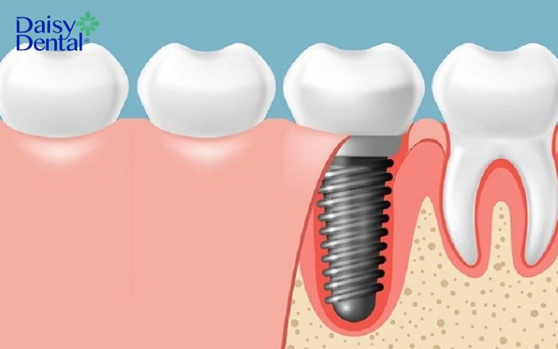Phương pháp cấy ghép Implant