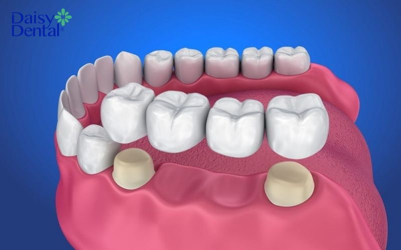 Sử dụng cầu răng sứ để làm răng giả cho người già