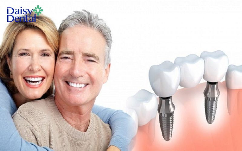Cấy ghép Implant tuy phức tạp nhưng có khả năng bảo tồn xương hàm tốt