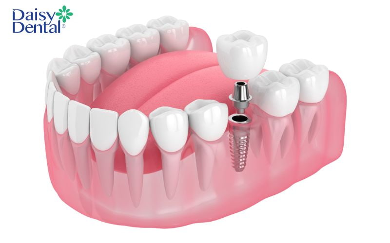 Sau khi cấy ghép Implant, bạn có thể sử dụng trong khoảng 25- 30 năm
