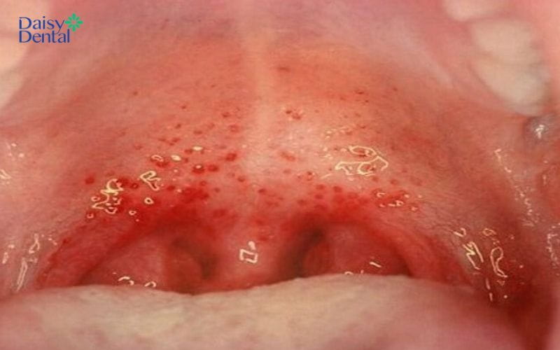 Vùng họng xuất hiện nhiều chấm đỏ