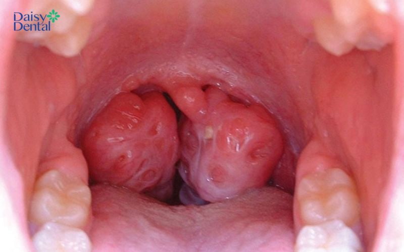Đây là tình trạng thanh quản của người bệnh bị viêm sưng, gây đau rát