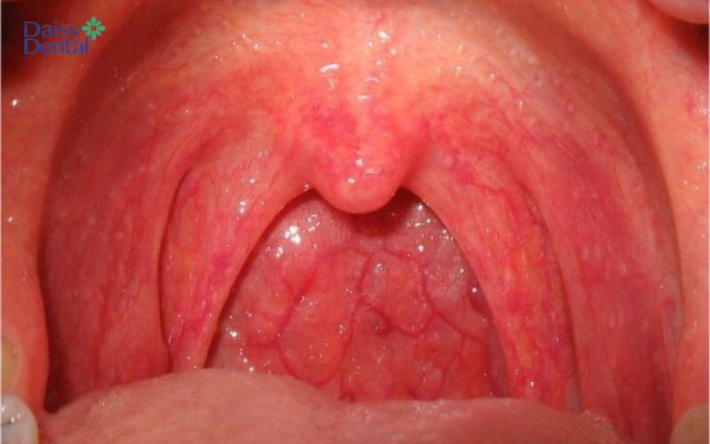  Niêm mạc họng có dấu hiệu sưng đỏ hơn so với bình thường