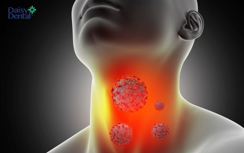  Đa số các trường hợp viêm thanh quản là do vi khuẩn, virus gây nên