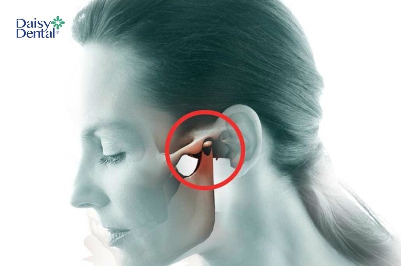 Viêm khớp thái dương hàm có hạch thường mắc phải ở phụ nữ mãn kinh