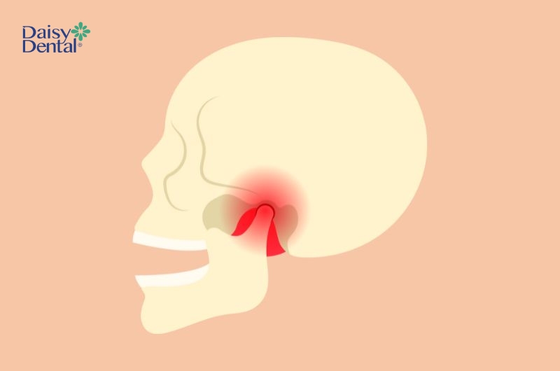 Bệnh lý này thường gây đau nhức và gây khó khăn khi cử động hàm.