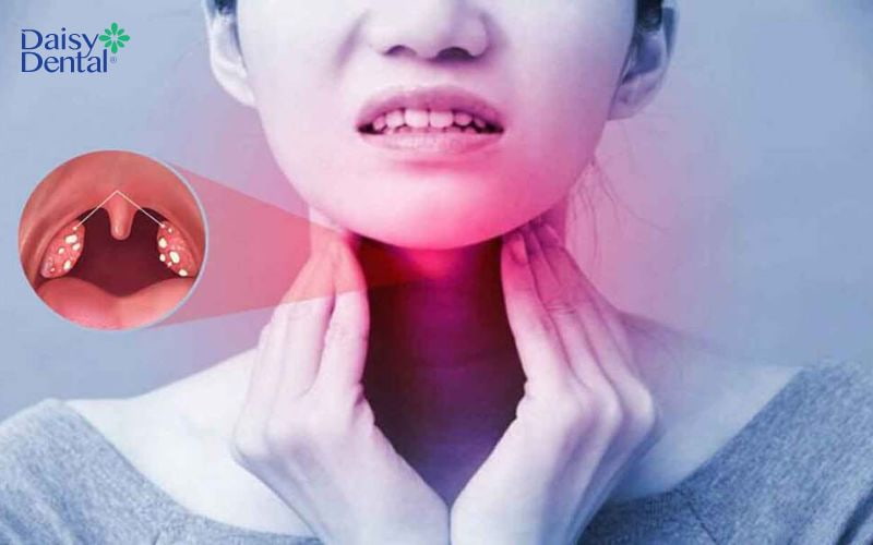 Họng bệnh nhân gặp tình trạng viêm nhiễm cấp tính