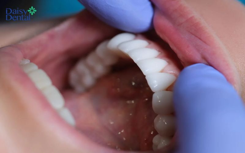 Vệ sinh răng miệng không tốt khiến họng dễ bị vi khuẩn tấn công