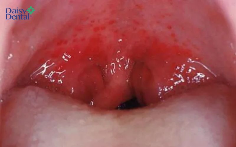 Niêm mạng họng sưng to và có nhiều nốt đỏ