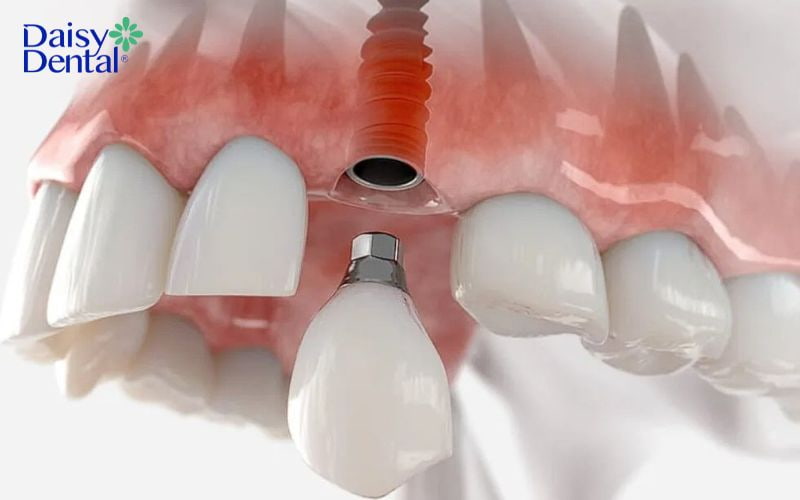 Implant ICX