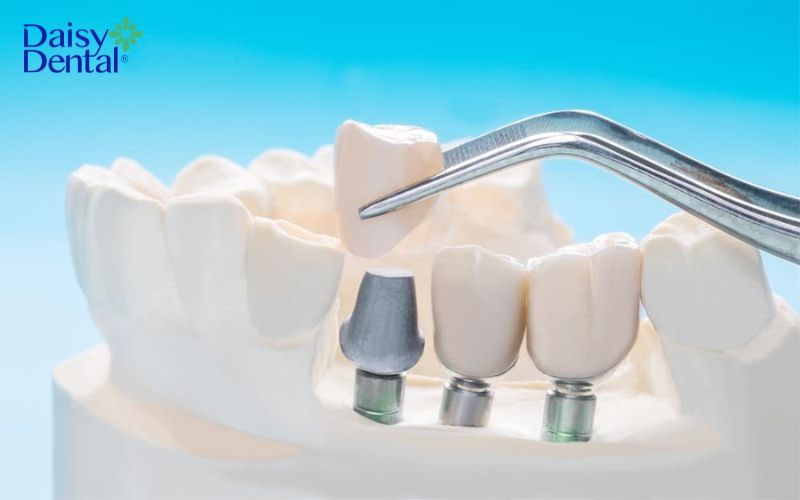 Implant ICX
