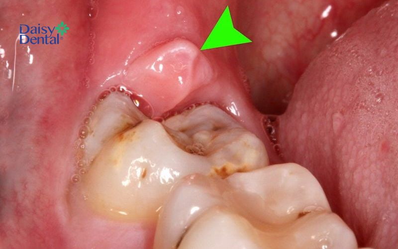 Áp xe răng sau có thể gây nên tình trạng áp xe má