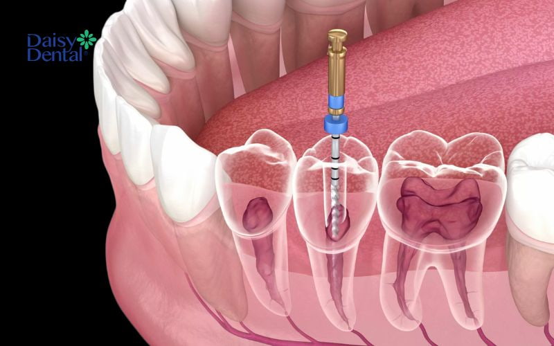 Điều trị tủy hoặc loại bỏ răng nếu áp xe do răng